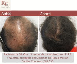 renacer capilar , tramientos para la alopecia en costa rica , tratamientos para la caida del cabello en costa rica , somos clinica dle pelo (1)