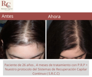 renacer capilar , tramientos para la alopecia en costa rica , tratamientos para la caida del cabello en costa rica , somos clinica dle pelo (10)