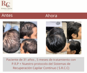 renacer capilar , tramientos para la alopecia en costa rica , tratamientos para la caida del cabello en costa rica , somos clinica dle pelo (11)