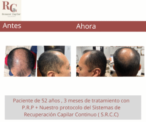 renacer capilar , tramientos para la alopecia en costa rica , tratamientos para la caida del cabello en costa rica , somos clinica dle pelo (12)