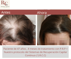 renacer capilar , tramientos para la alopecia en costa rica , tratamientos para la caida del cabello en costa rica , somos clinica dle pelo (1)8