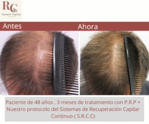 renacer capilar , tramientos para la alopecia en costa rica , tratamientos para la caida del cabello en costa rica , somos clinica dle pelo (2)