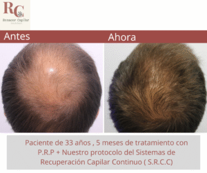 renacer capilar , tramientos para la alopecia en costa rica , tratamientos para la caida del cabello en costa rica , somos clinica dle pelo (6)