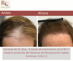 renacer capilar , tramientos para la alopecia en costa rica , tratamientos para la caida del cabello en costa rica , somos clinica dle pelo (7)