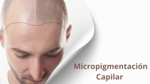 renacer capilar, tratamientos para la alopecia y caida del cabelloe en hombres y mujeres en costa rica (2)